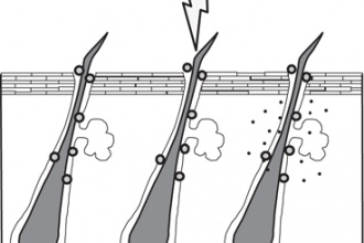 Adapalene pretreatment increases follicular penetration of clindamycin